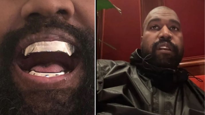 Noua dantură a lui Kanye West, din plăci de titan, a costat peste 850 de mii de dolari, scriu jurnaliștii din SUA