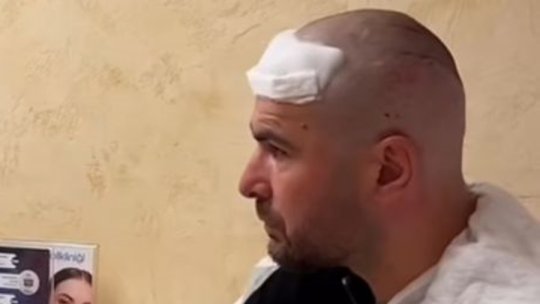 Primele imagini cu Adi Mutu după ce a făcut implant de păr. ”Briliantul”, de nerecunoscut: ”Nu vedeți și la interviuri că bate lumina?”