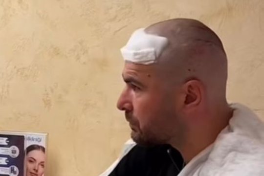Primele imagini cu Adi Mutu după ce a făcut implant de păr. ”Briliantul”, de nerecunoscut: ”Nu vedeți și la interviuri că bate lumina?”