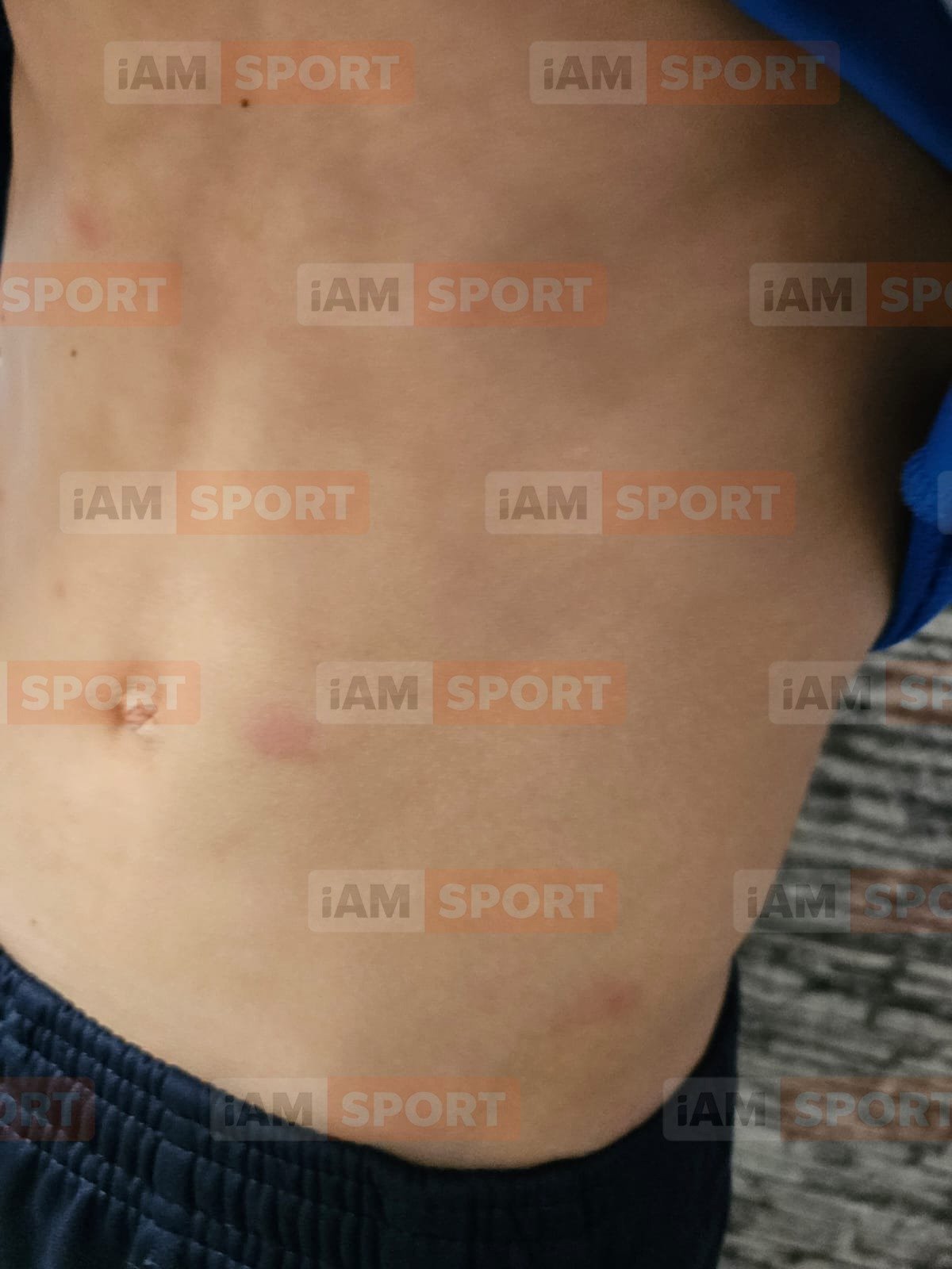 Copii ciupiți de ploșnițe la Băile Felix