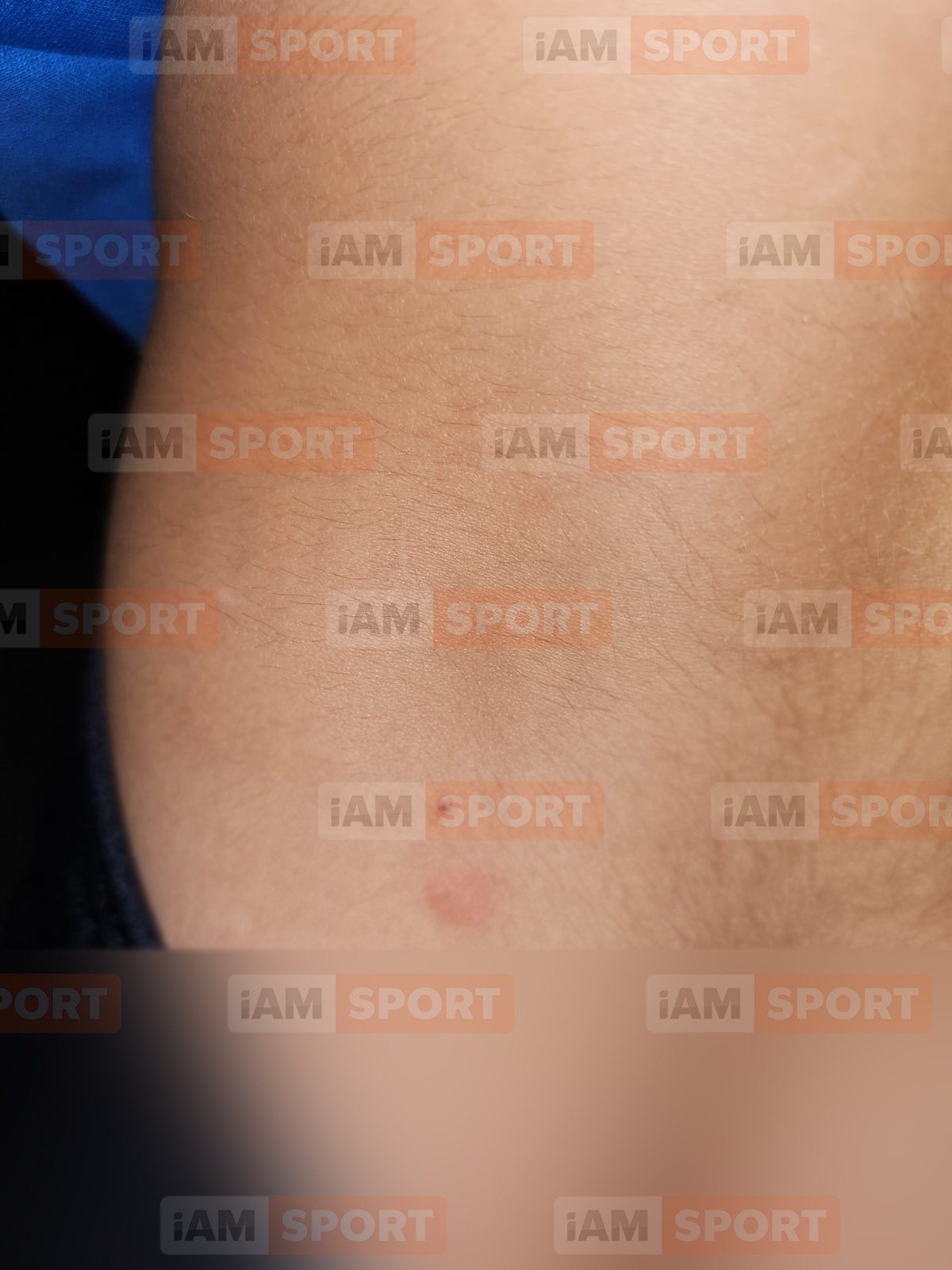 Copii ciupiți de ploșnițe la Băile Felix