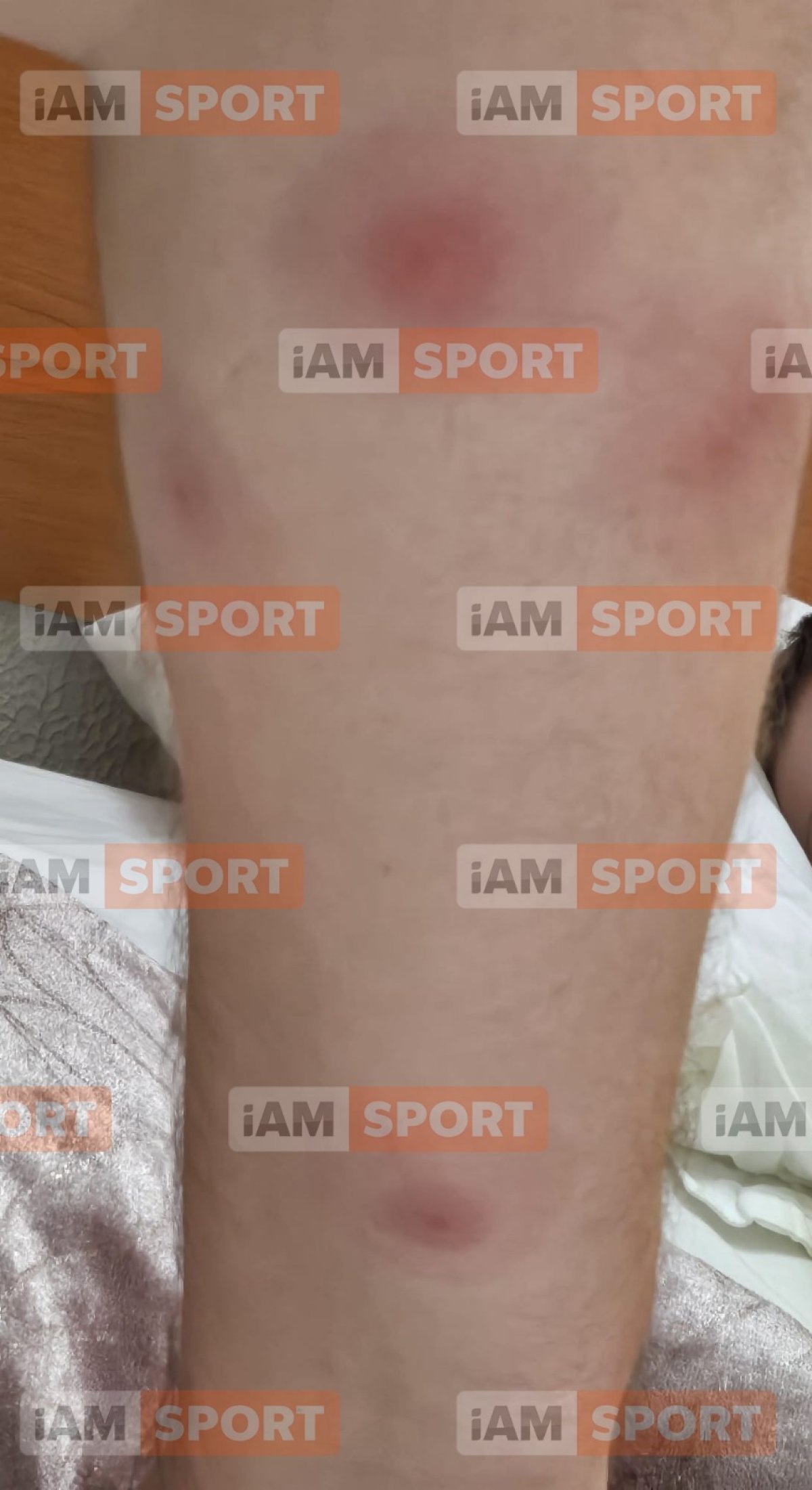 Parinte ciupit de plosnite