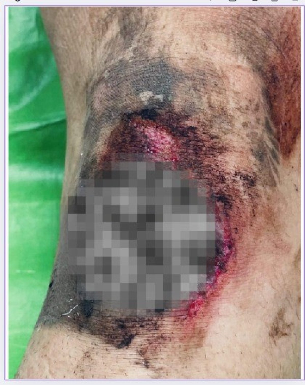 Așa arată rana lui Florian Haită