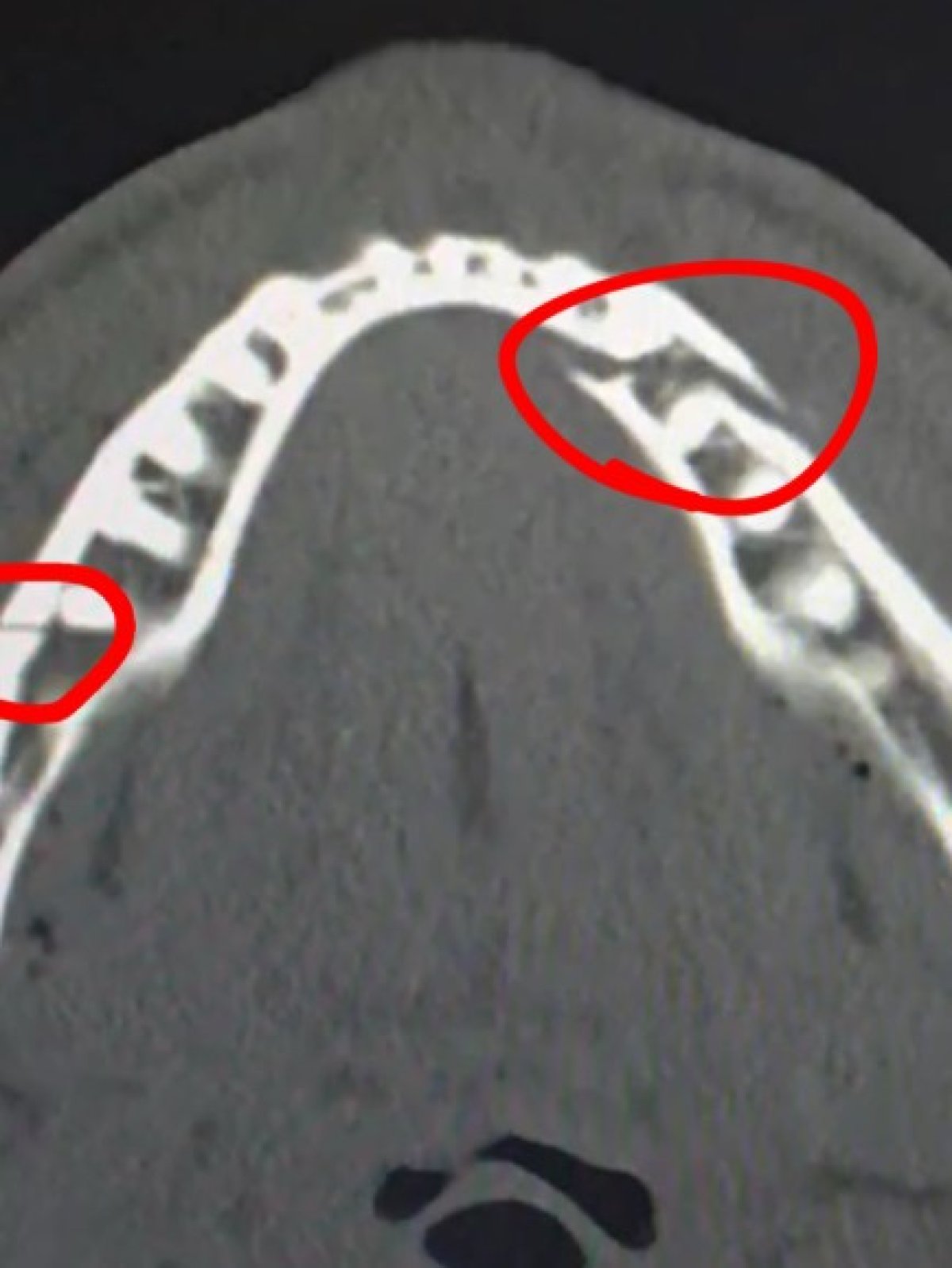Radiografia care arată fractura de mandibulă suferită de Jake Paul după loviturile primite de la Anthony Joshua