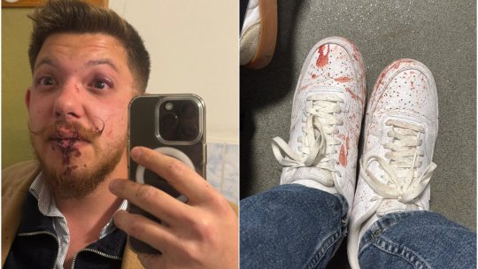 Scandal-monstru la Sepsi! Acuză direct că l-au desfigurat cu bătaia: ”Violență brutală!” + Cum au reacționat Dioszegi și cei implicați: ”Au început cu: «Du-te în p**a mea, ungure!»”