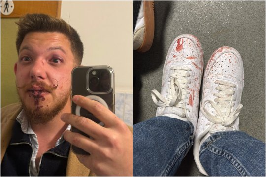 Scandal-monstru la Sepsi! Acuză direct că l-au desfigurat cu bătaia: ”Violență brutală!” + Cum au reacționat Dioszegi și cei implicați: ”Au început cu: «Du-te în p**a mea, ungure!»”